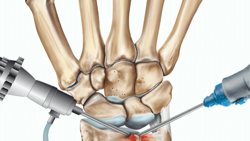 Wrist Arthroscopy