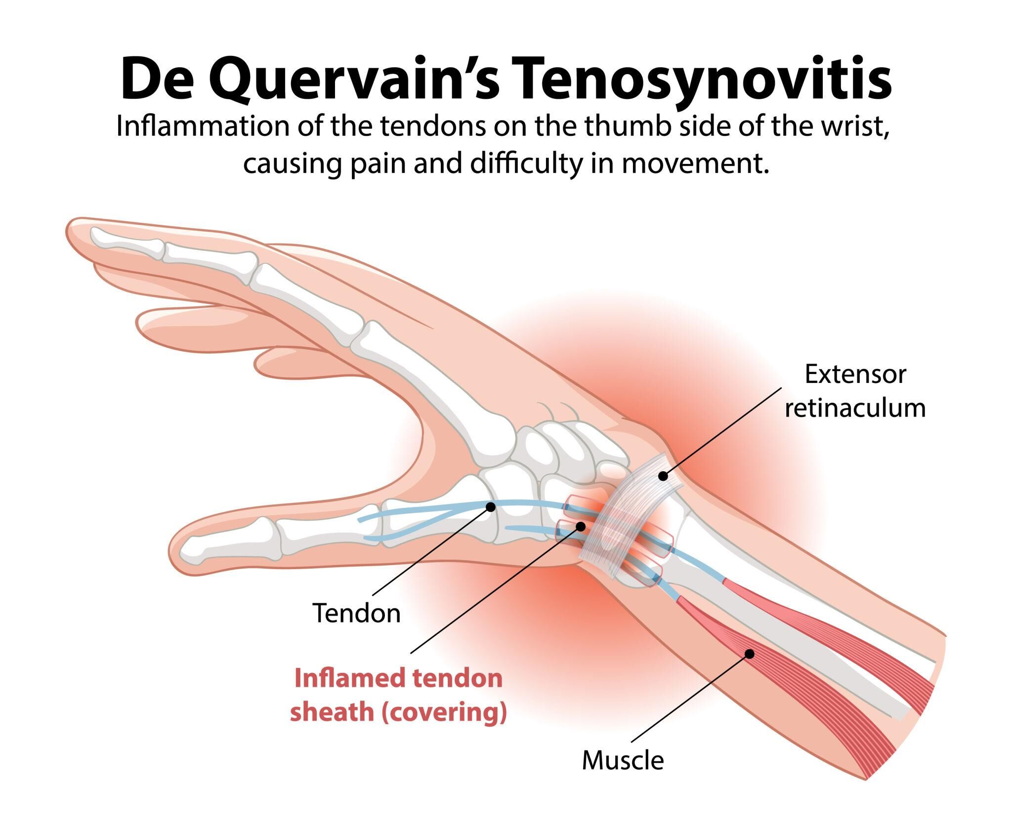 Best Hand Surgeon in Abu Dhabi for De Quervain’s Syndrome – Dr. Jayakrishnan Kurup Explains Thumb-Side Wrist Pain
